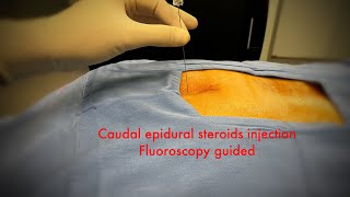 caudal epidural steroids injection fluoroscopystep by step [upl. by Preiser]