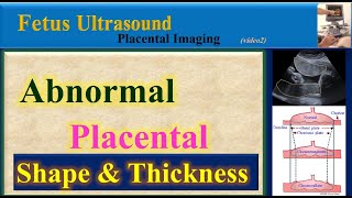 Fetus Ultrasound Abnormal Placental Shape and Thickness [upl. by Elladine418]