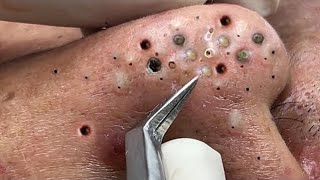 Big Cystic Acne Blackheads Extraction Blackheads amp Milia Whiteheads Removal Pimple Popping  2244 [upl. by Odelle915]