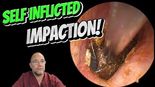 SELF INFLICTED IMPACTION 327 ear earwax earwaxremoval satisfying foryou fyp foryourpage [upl. by Eduard]