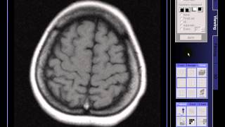 BRAIN MRI IN CASE EARLY ATROPHY [upl. by Cinomod]