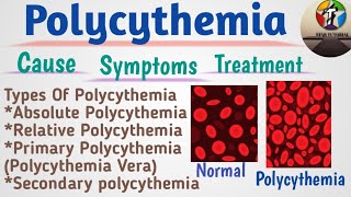 Polycythemia In Hindi ll Polycythemia Vera ll Hematology And Blood Banking [upl. by Aerdnael]