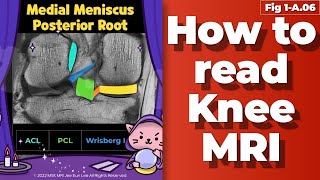 Fig 1A06 Medial Meniscus Posterior Root Anatomy degeneration tear [upl. by Atenahs]