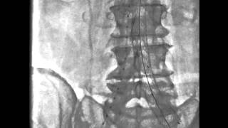 Correção de Aneurisma da Aorta Abdominal [upl. by Assenej]