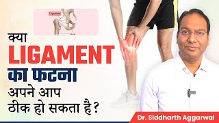 क्या Ligament Tear अपने आप ठीक हो सकता है  Ligament Injury amp Treatment  Dr Siddharth Aggarwal [upl. by Issi]