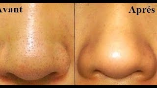 SUPPRIMER LES BOUTONS NOIR amp GRAISSE AU NEZ en 2 min Remove BLACKHEADS in just 2 min [upl. by Jeddy]