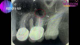 Apicoectomy of palatal root of maxillary 1st molar [upl. by Henrion]