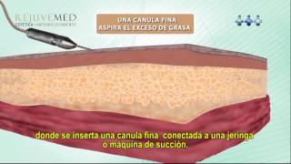 LIPOSUCCIÓN  VIDEO EXPLICATIVO [upl. by Hoffmann977]