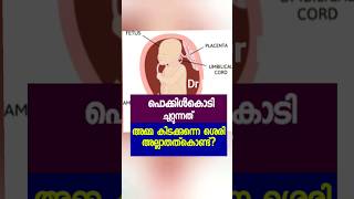 Cord around th fetal neck pregnancy malayalam trending cord pregnancycare [upl. by Howlond522]