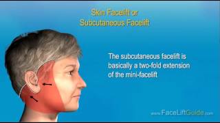 Steps of a Facelift Surgery [upl. by Gnil993]