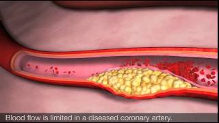 Angina and coronary heart disease [upl. by Esyla500]