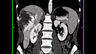 Abdomen Liver Cavernous Hemangioma of the Liver6 of 9 [upl. by Atileda]