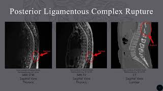 Posterior Ligamentous Complex Rupture [upl. by Wills]