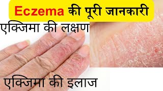 Eczema क्या हैं  Eczema की पूरी जानकारी  eczema kya hota hai  eczema ka ilaj [upl. by Tilden]