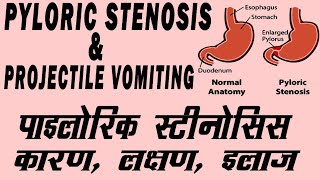 Projectile Vomiting in Infants  Infantile Hypertrophic Pyeloric Stenosis  IHPS [upl. by Griz]