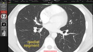 Lobar and Segmental Lung Anatomy on CT [upl. by Guido]