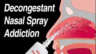 Decongestant Nasal Spray Addiction Afrin Zicam Sinex NeoSynephrine etc [upl. by Giusto]