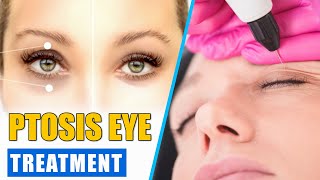 Ptosis Surgery  Ptosis of the Eye Explained  Ptosis Eye Treatment Eyelid Surgery [upl. by Naples]