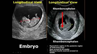 First Trimester amp Ectopic Pregnancy Ultrasound Image Appearances [upl. by Klein]