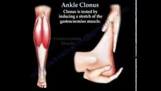 Ankle Clonus  Everything You Need To Know  Dr Nabil Ebraheim [upl. by Levitus]