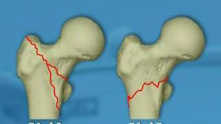 Proximal Femoral Nail Antirotation  PFNA [upl. by Lyndsey]