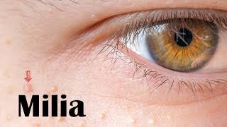 Milia  Types Causes And Treatment [upl. by Lacy]