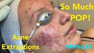 So much pop Acne extractions on severe inflammatory acne Multiple blackheads and whiteheads [upl. by Osmo834]