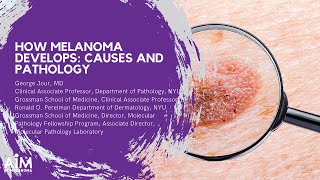 How Melanoma Develops Causes and Pathology [upl. by Xanthus]