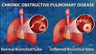 Breathe Easy in Understanding COPD 4 Minutes [upl. by Allicirp]