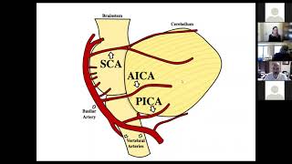 Management of Posterior Circulation Stroke Syndrome Sept 28 2021 [upl. by Arni]