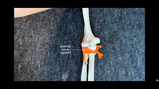 How to do a Nursemaids Elbow Reduction [upl. by Ahsel]