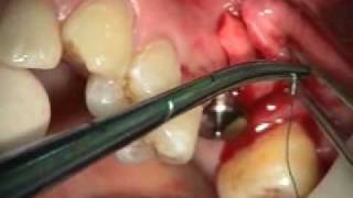 Implant Microsurgery Molar Implant and AlloDerm Augmentation [upl. by Talanian]