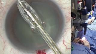 ZEPTO® Precision Cataract Surgery Technology Safety Performance [upl. by Gairc]