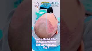 Khairul Fahmi  Apek FUE Hair Transplant with Clinic Dr Inder [upl. by Antonetta989]