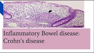 Crohns disease PathogenesisMorphology and clinical features [upl. by Slosberg]