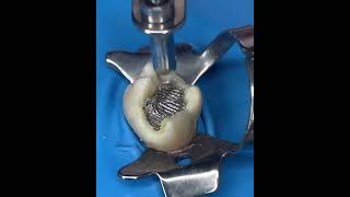 Tooth Filling  Silver filling Amalgam FillingClass 1 [upl. by Nek]