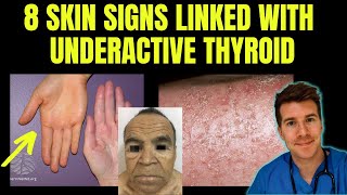 Doctor explains 8 SKIN SIGNS linked with HYPOTHYROIDISM aka underactive thyroid [upl. by O'Meara551]