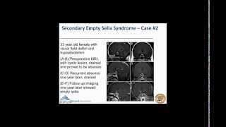 Empty Sella Syndrome [upl. by Semadar]