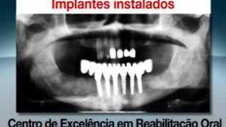 Implantes dentários com carga imediata [upl. by Esinereb]