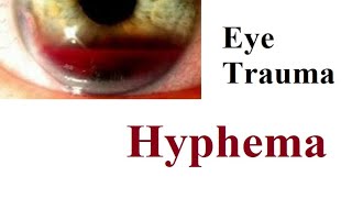 Hyphema [upl. by Bringhurst772]