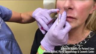 Juvederm Volbella Demo for Perioral Lines around the lips  2068595777 [upl. by Nashbar777]