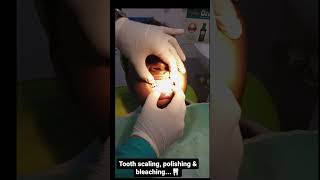 tooth scalingpolishing amp bleaching [upl. by Melburn]