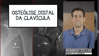 Osteólise Distal da Clavícula [upl. by Cenac]