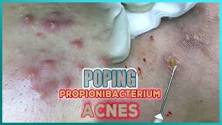 Big Cystic Acne Blackheads Extraction Blackheads amp Milia Whiteheads Removal Pimple Popping [upl. by Amled]