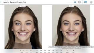 Realistic smile visuals with Invisalign® Outcome Simulator Pro [upl. by Diego]