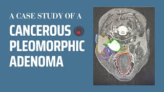 Can benign parotid tumors turn cancerous  Pleomorphic adenoma case study [upl. by Edialeda]