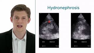 How To Evaluate Hydronephrosis In Point of Care Ultrasound [upl. by Steward474]