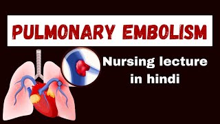 Pulmonary Embolism in hindi  cause pathophysiology symptoms management  nursing lecture [upl. by Nallaf570]