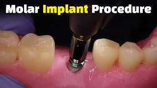 Step by Step Dental Implant Procedure  Back Molar [upl. by Sarat]