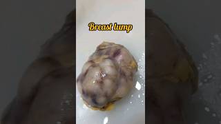 Breast lump excision biopsy for histopathology😨 breastcancer breastdisease breastfeeding lump [upl. by Maer495]